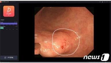 본문 이미지 -  혁신의료기기로 지정된 &#39;웨이메드 엔도&#39;&#40;WAYMED endo ST CS&#41;&#40;식품의약품안전처 제공&#41;