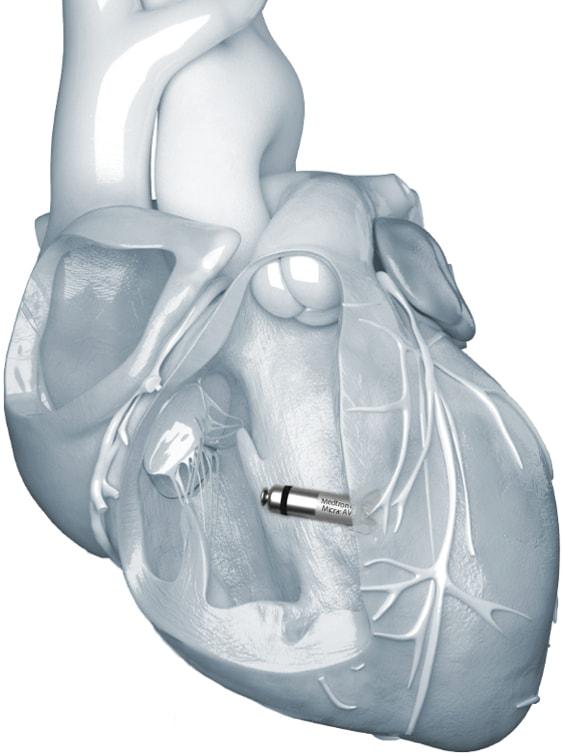 본문 이미지 - 마이크라가 심장 내부에 삽입된 모습. 별도의 배터리나 전극선 없이 심장 박동을 조율한다. /메드트로닉 제공