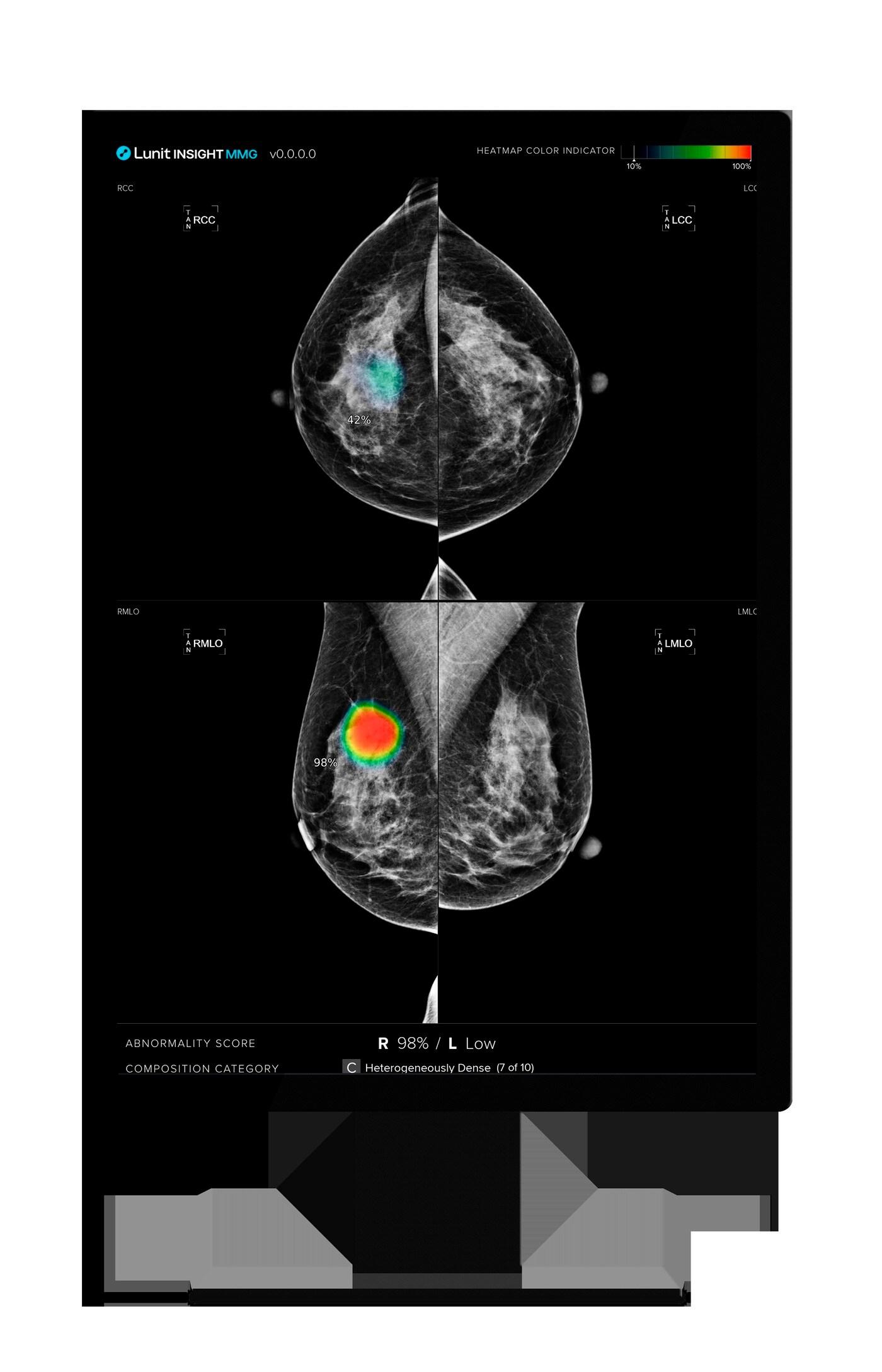 본문 이미지 - 루닛 인사이트 MMG 활용 모습.&#40;루닛 제공&#41;/뉴스1