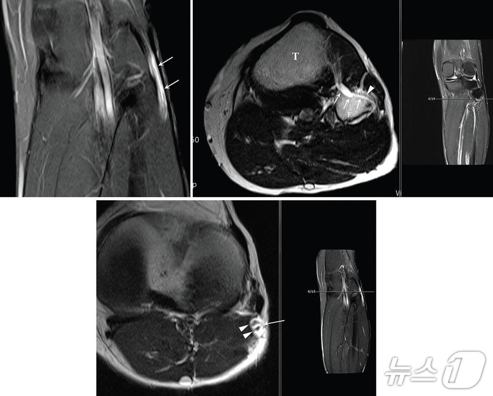 본문 이미지 - 가톨릭대학교 서울성모병원은 손병철 신경외과 교수가 최근 미국 메이요 클리닉(Mayo Clinic) 신경외과의 로버트 스피너(Robert J. Spinner) 교수팀과 공동 연구를 통해 말초신경 마비를 유발하는 신경내 결절종(intraneural ganglion cyst)의 복잡한 발생 기전을 규명했다고 13일 밝혔다.사진은 신경내 결절종의 MRI(자기공명영상) 장치 검사사진.(가톨릭대학교 서울성모병원 제공)