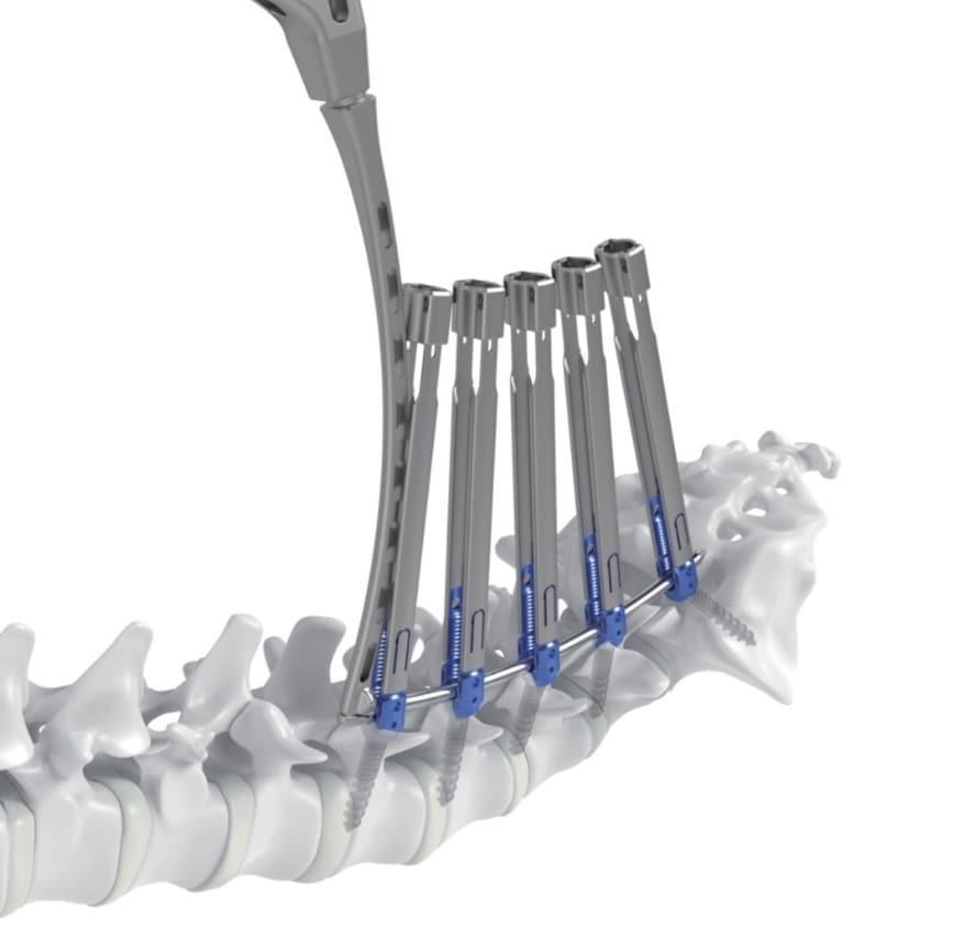 본문 이미지 - 메드트로닉코리아가 ‘강휘’를 출시하며 메드트로닉 척추 솔루션에 대한 접근성을 확대한다. (메드트로닉코리아 제공)