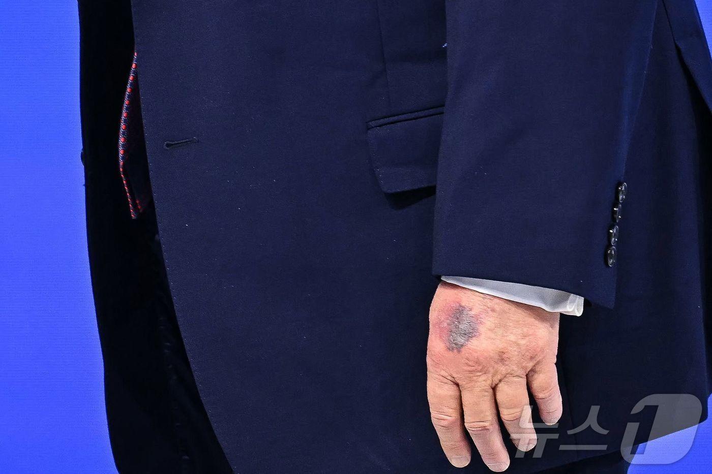 본문 이미지 - 22일(현지시간) 스위스 다보스에서 열린 세계경제포럼(WEF) 연차총회(다보스포럼)에 참석한 도널드 트럼프 미국 대통령의 왼손 손등에 멍이 들어 있다. 2026.01.22. ⓒ AFP=뉴스1 ⓒ News1 윤다정 기자