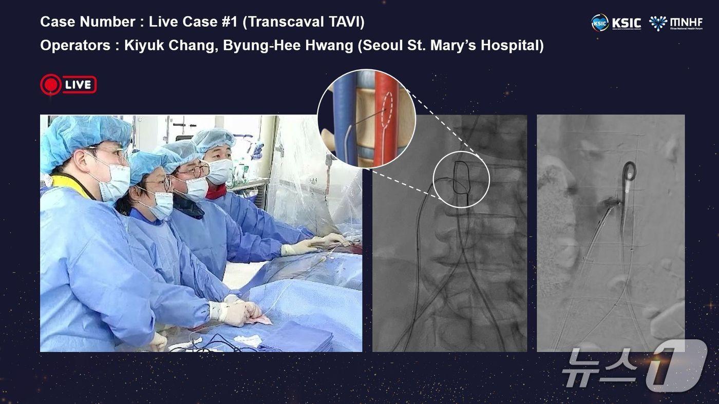 본문 이미지 - 시술 모식도(서울성모병원 제공)