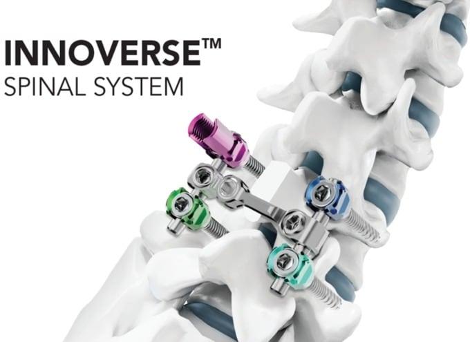 본문 이미지 - 시지메드텍의 척추 고정 장치 '이노버스 스파이널 시스템'(INNOVERSE Spinal System). (대웅 제공) 