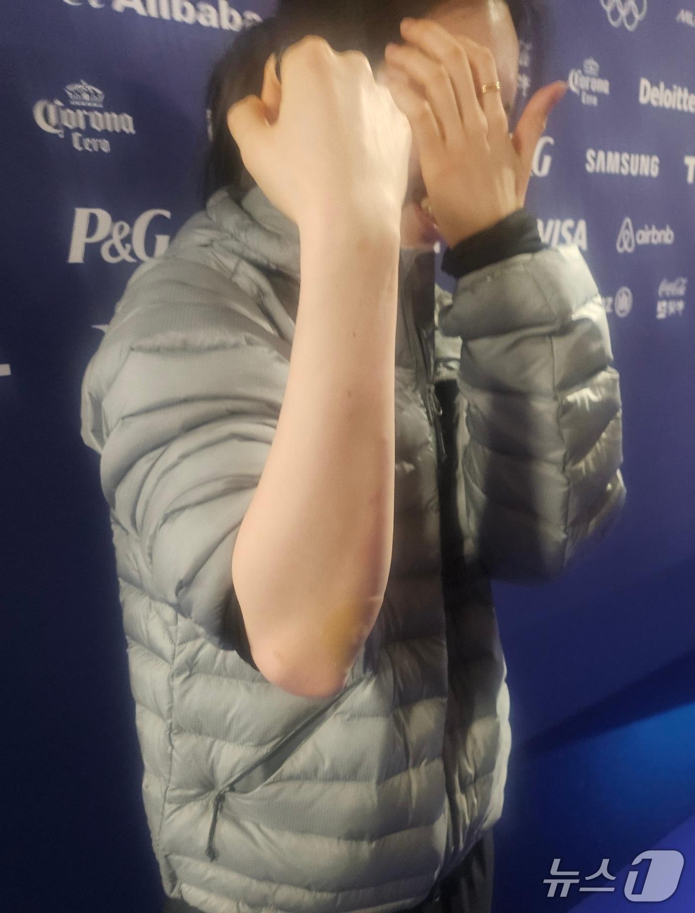 본문 이미지 - 김길리가 11일(한국시간) 이탈리아 밀라노 아이스 스케이팅 아레나에서 훈련을 마친 뒤 취재진에 자신의 상처 부위를 보여주고 있다. ⓒ 권혁준 기자