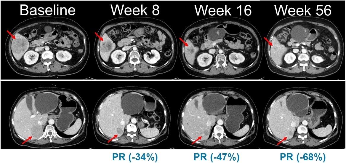 본문 이미지 - NRAS 돌연변이 흑색종 환자를 대상으로 진행된 벨바라페닙과 코비메티닙 병용요법 임상시험에서 시간 경과에 따른 병변 변화가 관찰된 복부 CT 영상.(한미약품 제공)/뉴스1