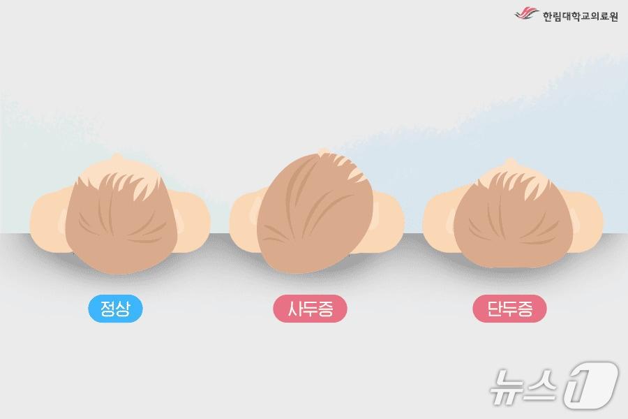 본문 이미지 - 자세형 사두증의 유형.(한림대학교 동탄성심병원 제공)