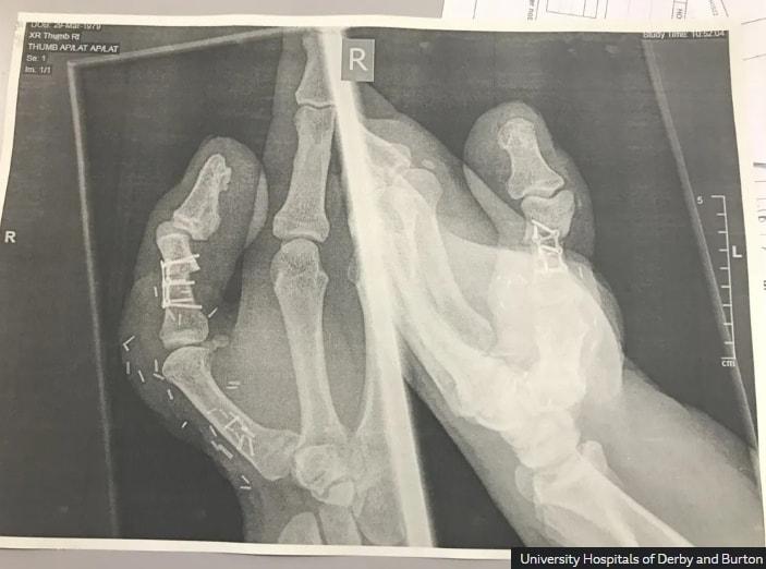 본문 이미지 - 엄지발가락 이식후 사진. BBC