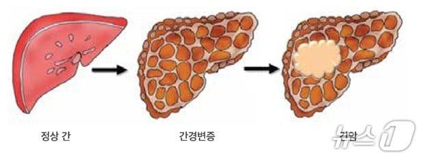 본문 이미지 - 간암 진행 과정(대한간암학회·서울대병원 제공)