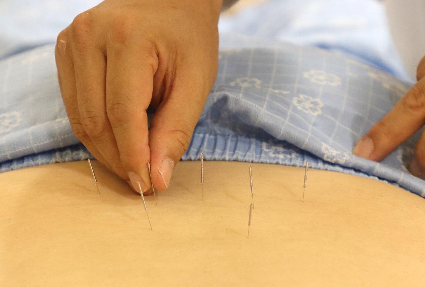 본문 이미지 - 자생한방병원 의료진이 허리 통증을 호소하는 환자에게 침 치료를 실시하고 있다.(자생한방병원 제공)