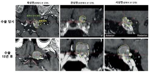 본문 이미지 - 55세 여성 환자의 시신경 인접 수막종 수술 당시(상단)와 15년 후(하단) MRI 영상. 수술 당시 시신경 보호를 위해 종양 일부에 방사선을 쏘지 않았으나 15년 뒤 과거 방사선을 피했던 부위에서 종양이 다시 자라났다. (서울대병원 제공)