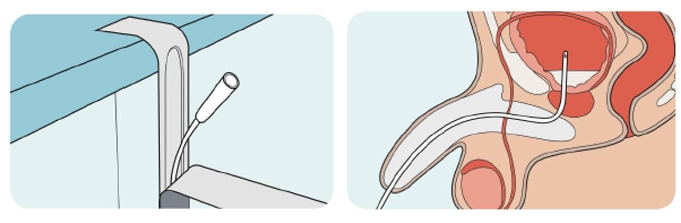 본문 이미지 - 신경인성 방광 환자가 일회용 카테터를 방광에 삽입하여 방광을 비우는 '청결 간헐적 도뇨법'.(서울성모병원 제공)