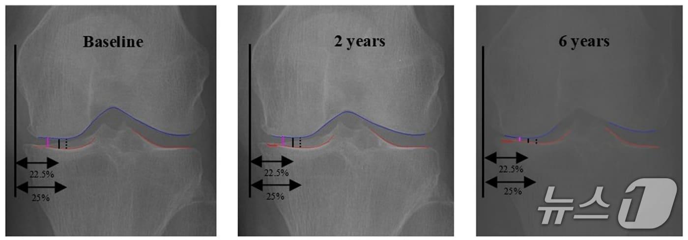 본문 이미지 - 초기, 2년, 6년 시점별 관절 간격 측정 비교. AI가 찾은 oJSW(보라색)가 기존 방식(검은색)보다 정밀한 추적 관찰을 가능하게 한다.(서울대병원 제공)