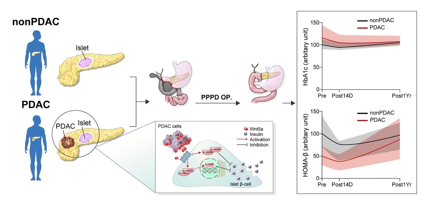 본문 이미지 - 췌장암 연관 고혈당과 관련 병태생리 기전 모식도.(연세대 강남세브란스병원 제공)