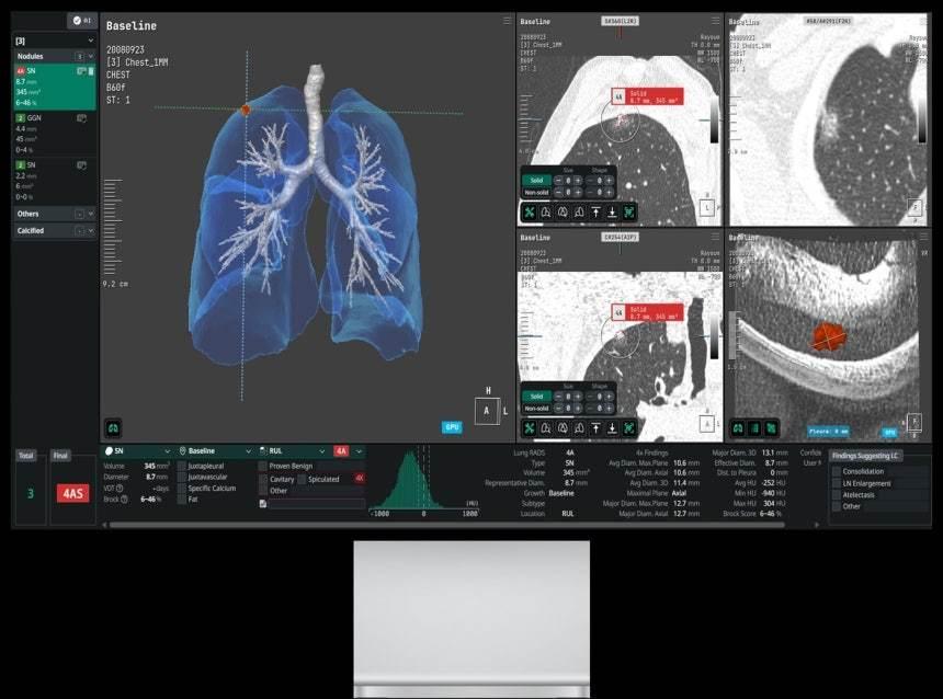 본문 이미지 - 코어라인소프트 솔루션 '에이뷰'(AVIEW). (코어라인소프트 제공)