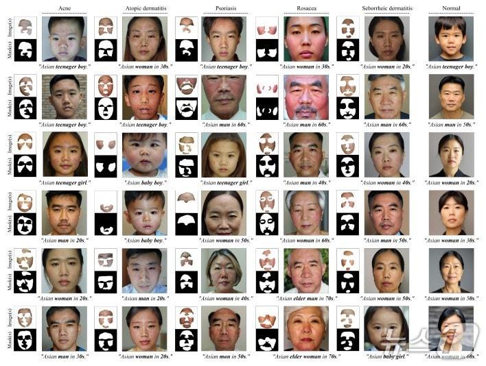 본문 이미지 - 피부 질환 임상 사진 적용 사례. 환자의 신원은 보호하면서도 진단에 필수적인 피부 병변(여드름, 건선 등)은 훼손 없이 보존했다.(서울대병원 제공)