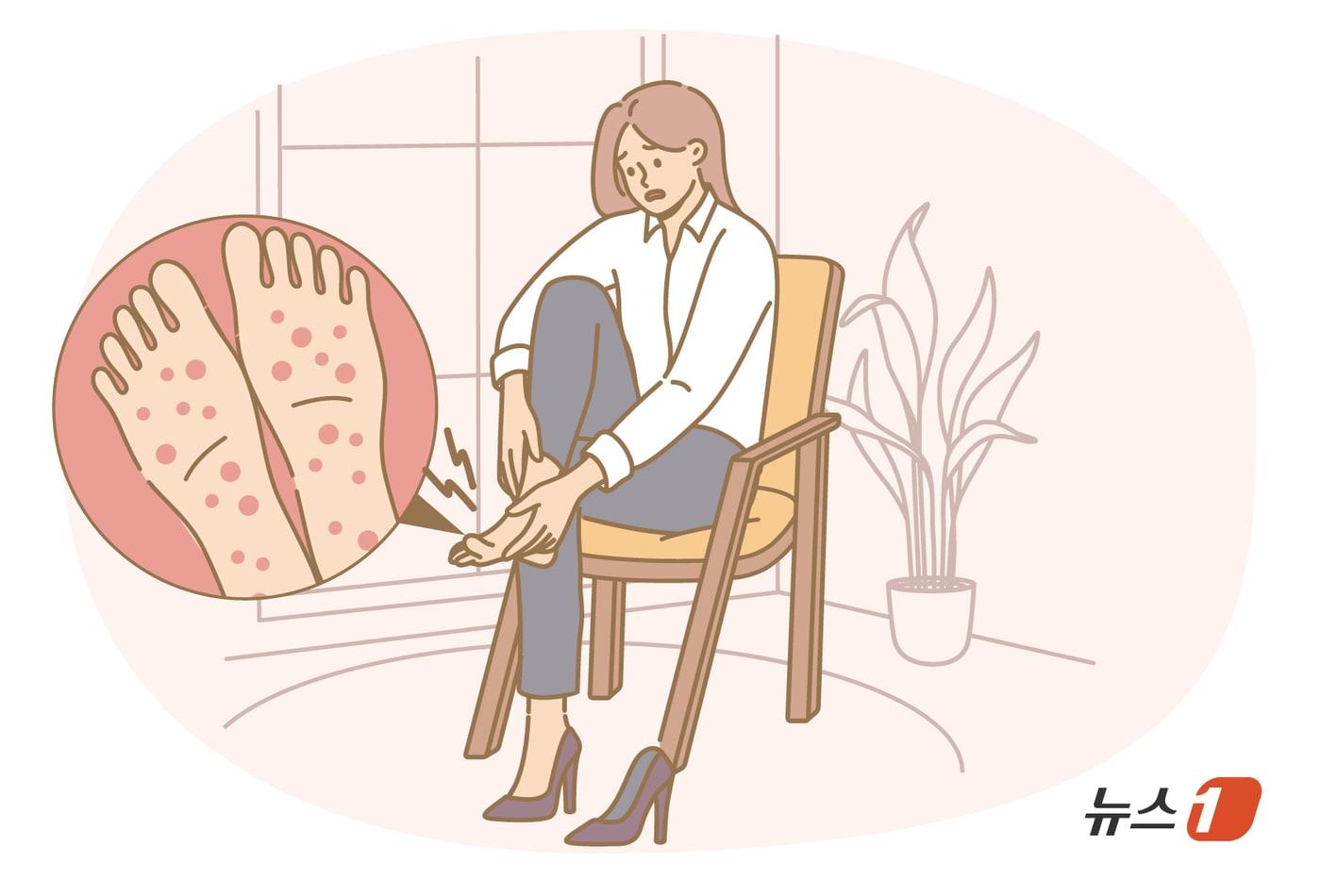 본문 이미지 - 손바닥과 발바닥에 반복적으로 물집과 농포가 생기고 통증과 가려움이 지속되는 증상이 나타난다면 단순한 피부 트러블이 아닌 손발바닥농포증(Palmoplantar Pustulosis, PPP)일 수 있다. 다만 다른 질환으로 오인되거나 정확한 진단이 늦어지는 경우가 많다는 게 문제다. 