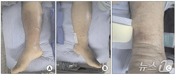 본문 이미지 - 최초 증상 발생 20일 후 임상 증상. A는 오른쪽 하지의 부종. B는 왼쪽 하지의 부종. C는 왼쪽 하지의 수포성 상처. (질병청 제공)