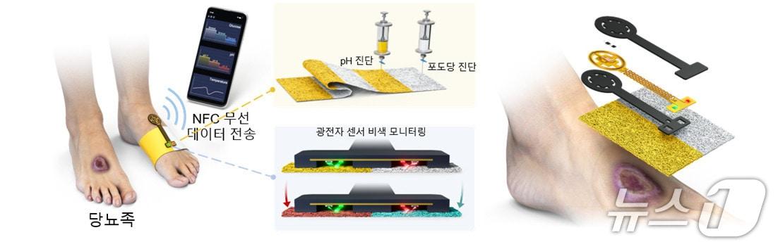 본문 이미지 - 당뇨족 및 당뇨성 질환 진단을 위한 다중모달 비색 드레싱 및 광전자 센서의 개념도(KAIST 제공) /뉴스1