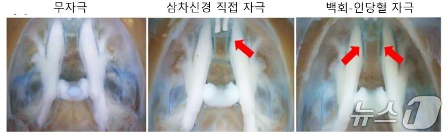 본문 이미지 - 경혈 침 치료에 따른 감차신경절 활성화(한국한의학연구원 제공) /뉴스1