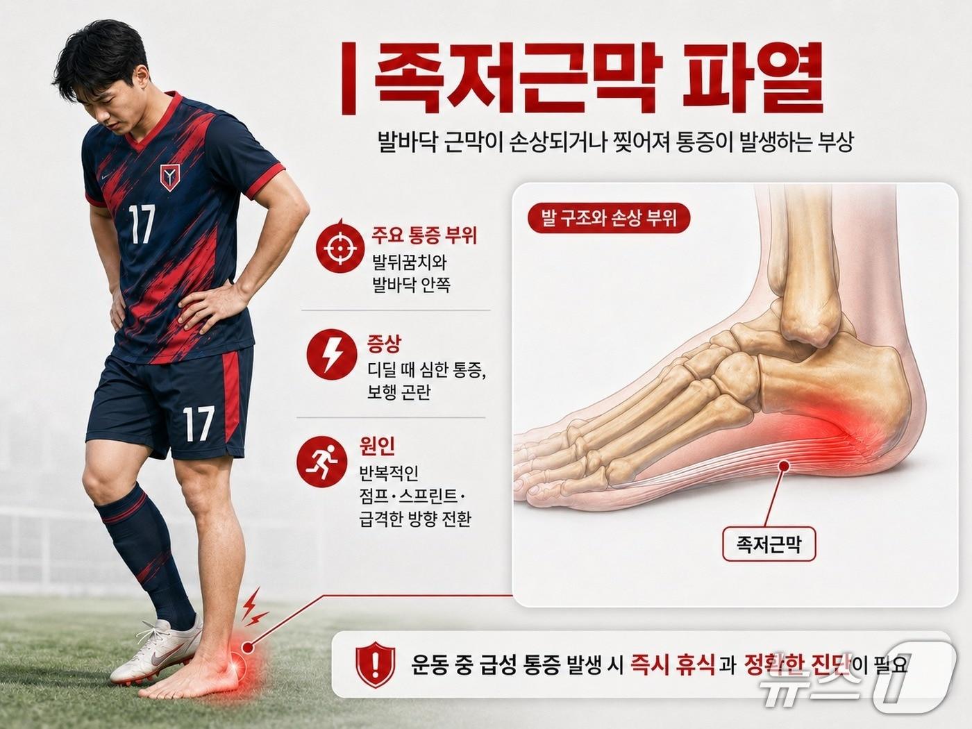 본문 이미지 - 족저근막 파열에 대한 원인과 증상(AI 생성 이미지·자생한방병원 제공.)