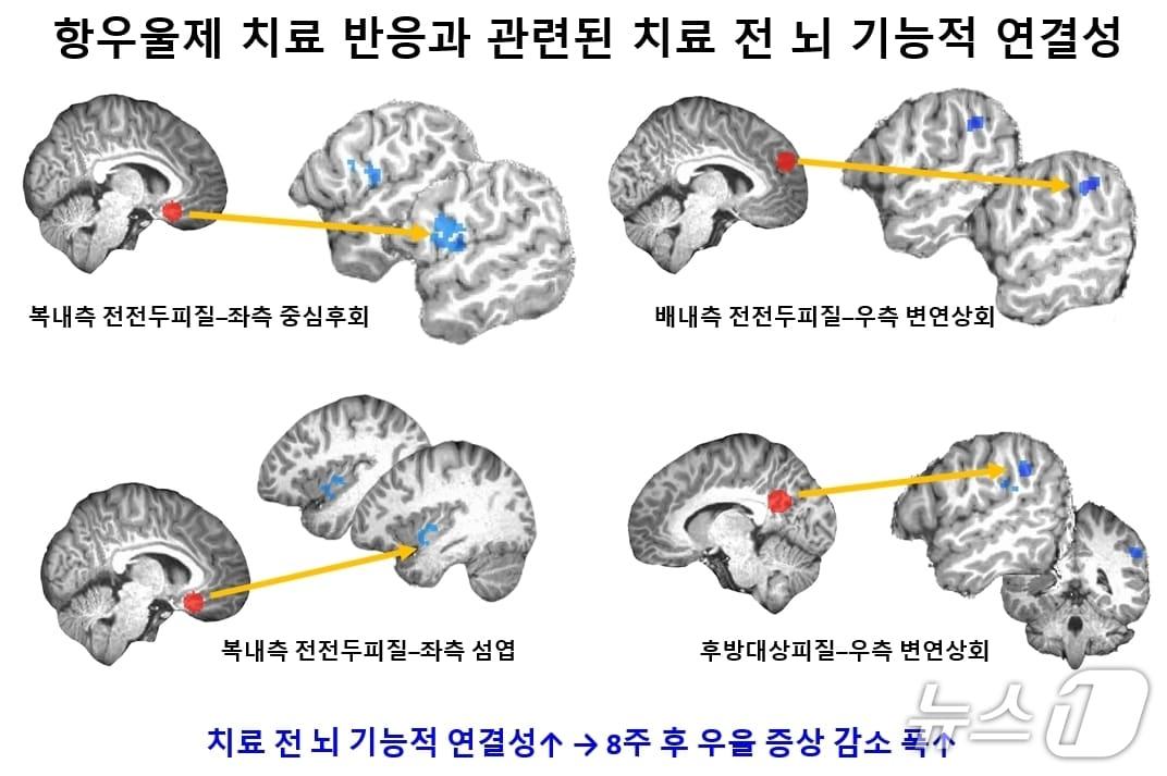 본문 이미지 - 항우울제 치료 반응과 관련된 뇌 기능적 연결성.(서울대병원 제공)