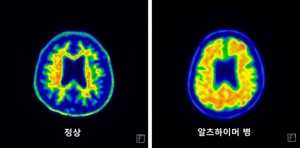본문 이미지 - 아밀로이드 축적을 관찰한 '아밀로이드 PET' 영상. 왼쪽이 정상 뇌, 오른쪽이 알츠하이머병 환자의 뇌. (서울성모병원 제공)
