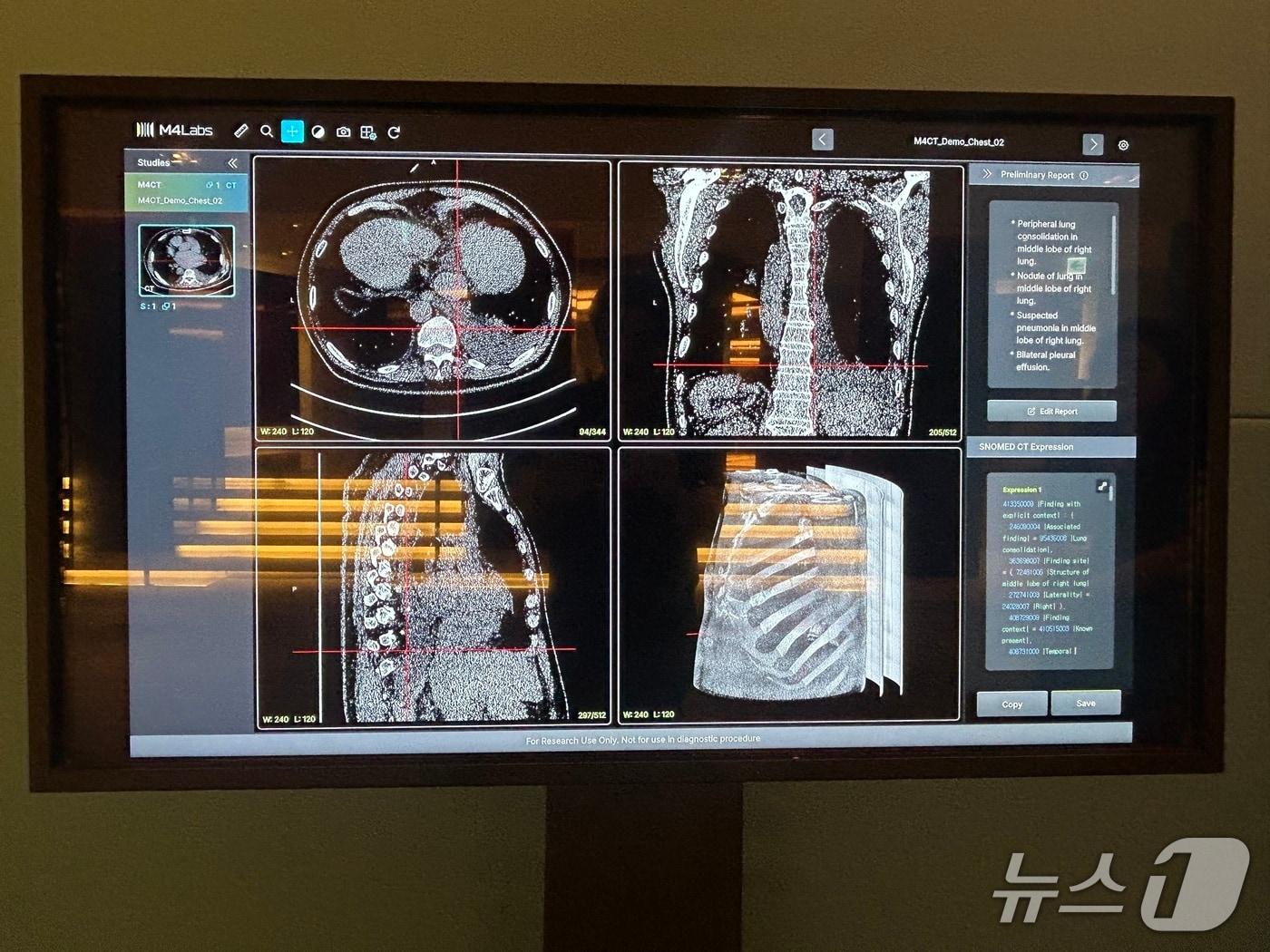 본문 이미지 - 딥노이드 생성형 AI 의료기기 'M4CXR'. 2026.7.13 ⓒ 뉴스1 문대현 기자 