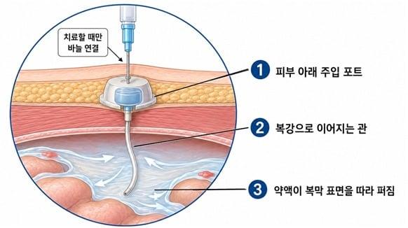 본문 이미지 - 복강 내 파클리탁셀 주입 치료 개념도. (분당서울대병원 제공)