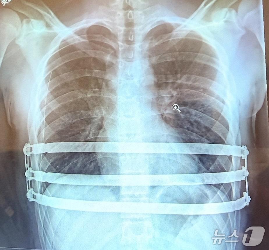 본문 이미지 - 자로주스키 박사가 팩투스(Pectus) 수술을 집도 한 후 촬영한 흉부 엑스레이(X-ray) 영상 이미지 (엘앤케이바이오메드 제공)