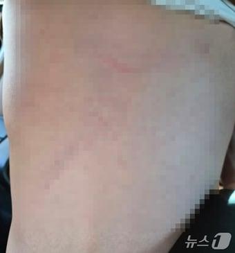 본문 이미지 - 대구 달서구 장애 전담 어린이집  아동학대 피해 아동의 등 사진(독자 제공)