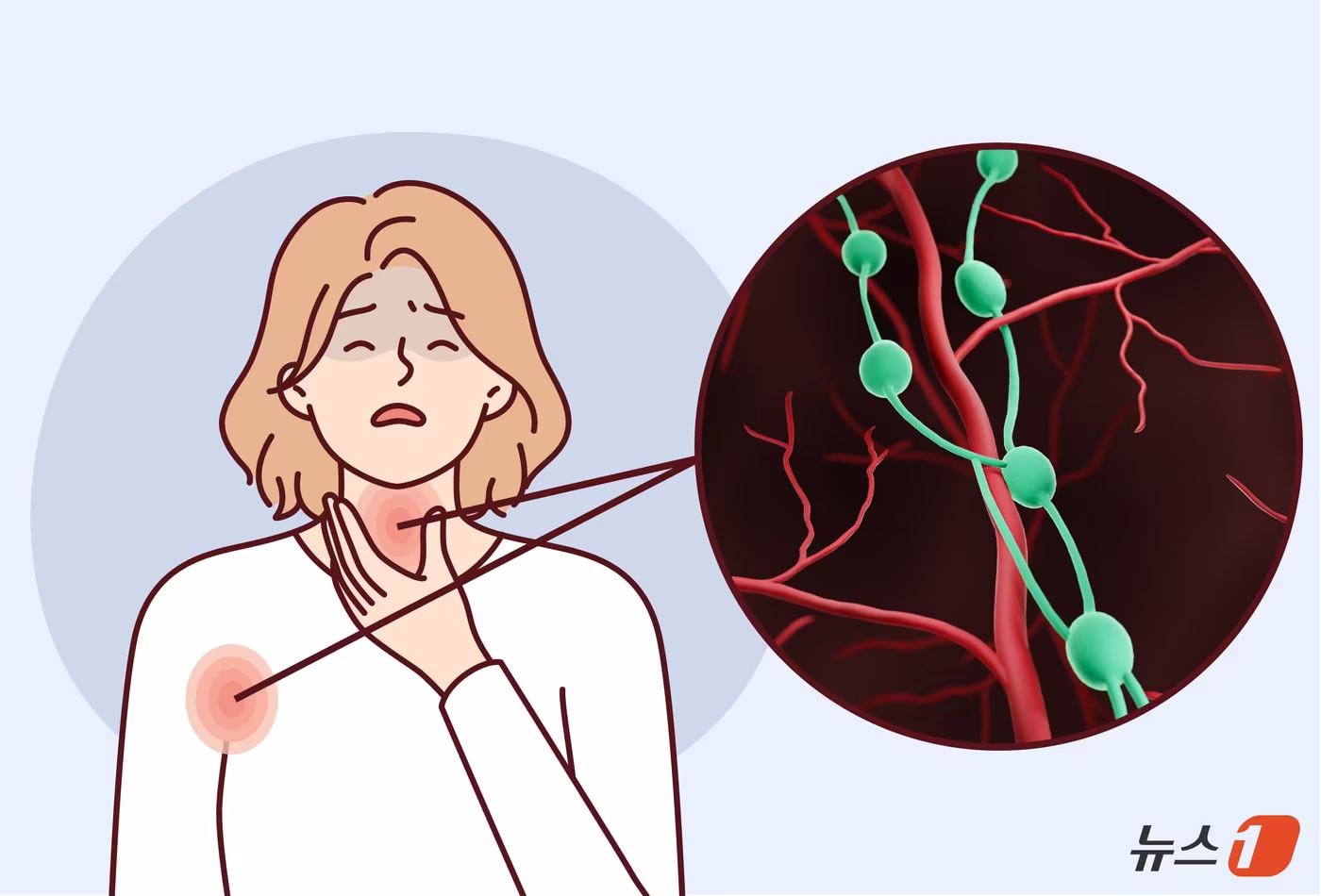 본문 이미지 - 우리 몸 곳곳에는 세균과 바이러스 등 외부 물질을 걸러내고 면역 반응을 돕는 림프절이 있다. 목이나 겨드랑이, 사타구니에서 통증 없는 멍울이 갑자기 커지거나 원인 모를 발열과 체중 감소, 식은땀이 이어진다면 림프종을 의심할 필요가 있다. ⓒ 뉴스1 윤주희 디자이너