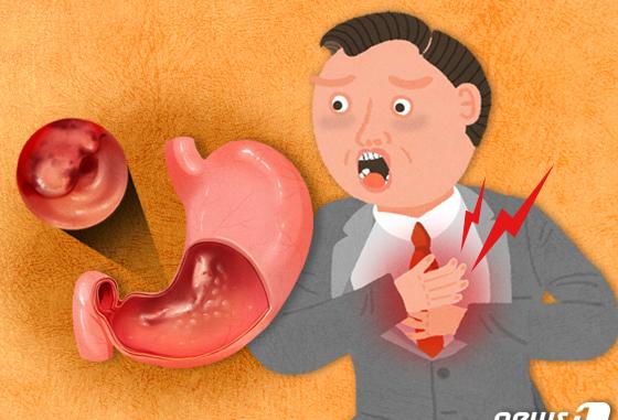 1차 위암검진 때 위내시경 우선 권고…10년 만에 규정 변화