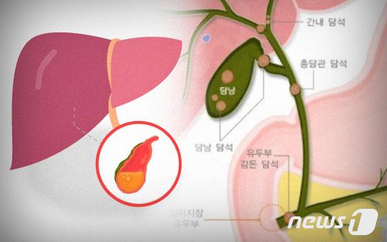 "살 빨리 빼려다 돌 생긴다"…담석증, 10년 새 2배