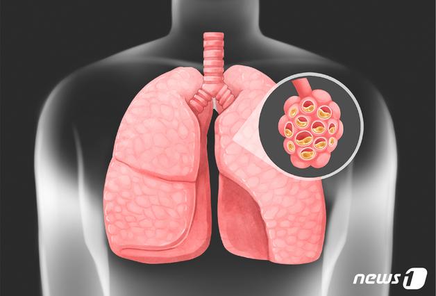 "기침 오래간다 했더니"…스펀지 같던 폐가 굳는 '이 병'