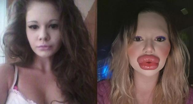 "입술 필러에 3800만원 쓴 여성…의사도 '흉해' 시술 거부"