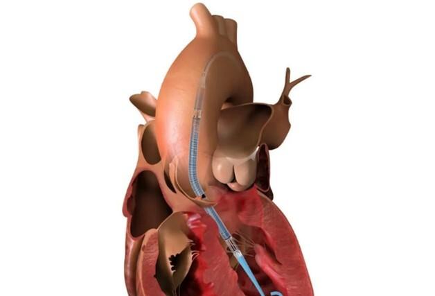 존슨앤드존슨, 초소형 인공심장펌프 '임펠라CP' 국내 출시