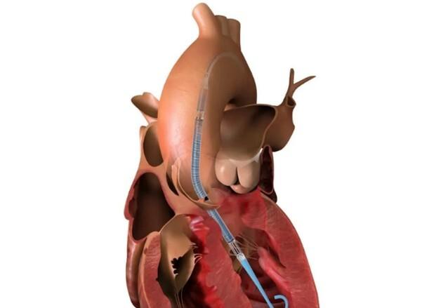 존슨앤드존슨, 초소형 인공심장펌프 '임펠라CP' 국내 출시