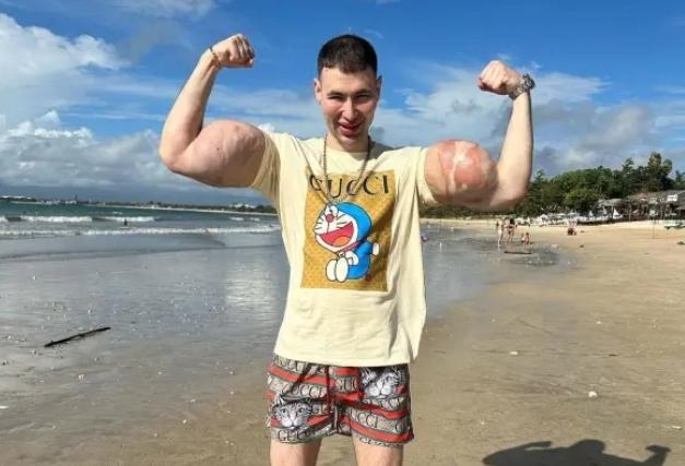 이두박근에 석유젤 넣어 뽀빠이 팔 갖게 된 '근육맨'…두 팔 잃을 위기에