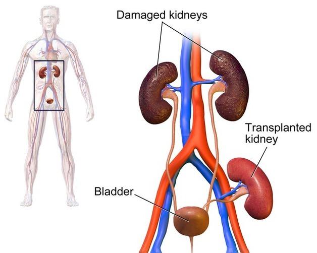 의학사의 기적, 최초의 신장 이식 성공