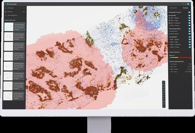 담도암 HER2 진단에 AI 활용 가능성 확인…전문의와 83.5% 일치