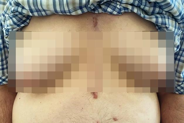 76세男 웃통 벗으니 '여성 가슴'…"고혈압약 때문"