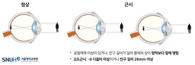 '고도 근시→시력 손상' 이어져…정기 안과검진 필수
