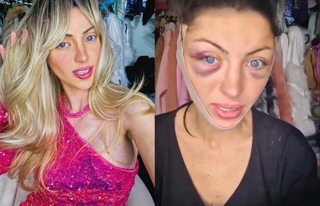 30번 성형 '인간 바비' 인플루언서, 속옷 차림으로 사망 미스터리