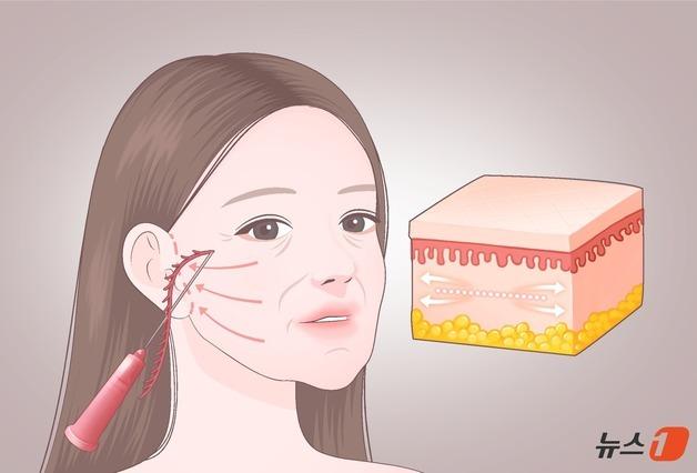 'K-미용의료 풀세트' 무바늘·레이저·HIFU 잘팔리네…수출 1조 원 돌파