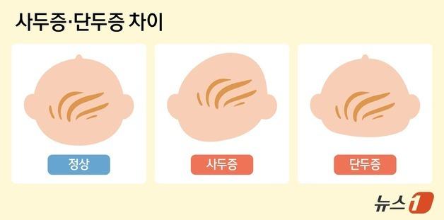 "우리 아기 머리모양 괜찮을까"…'사두증' 뭐길래, 300만원 헬멧 '불티'