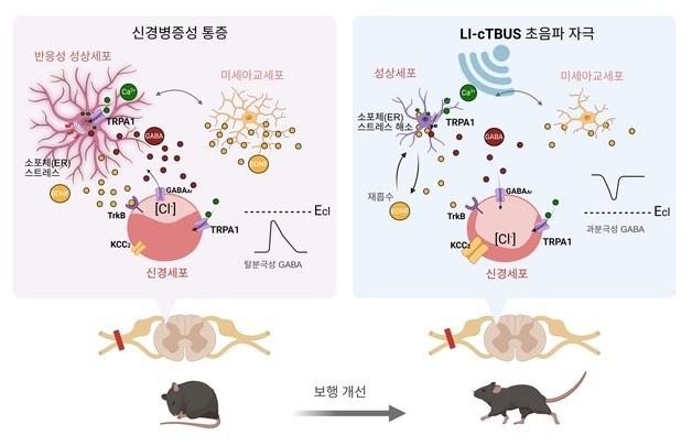 IBS, 뇌파 모사 초음파로 만성 신경병증성 통증 장기적 완화 성공