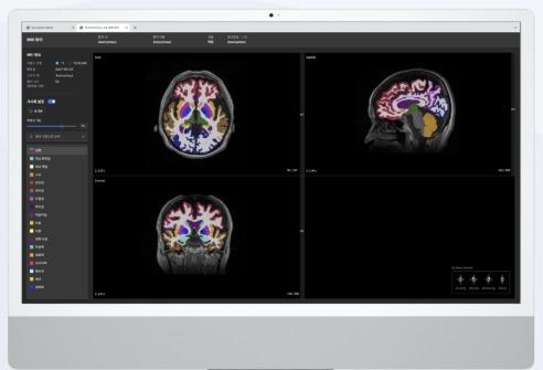 뉴로핏, 한국에자이와 '뉴로핏 아쿠아' 치매 진단 서비스 MOU 체결