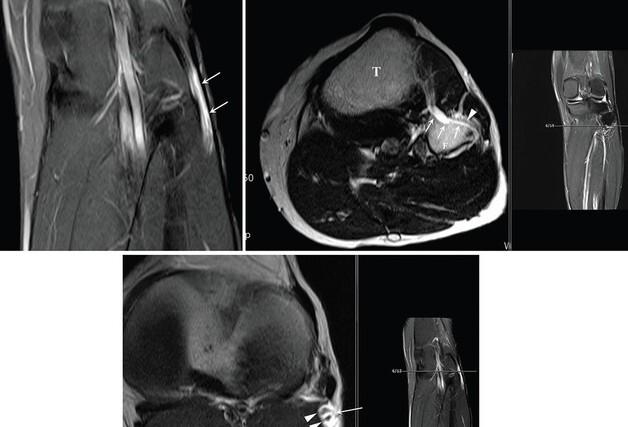 손병철 서울성모병원 교수, 희귀 난치성 양성종양 발생 기전 확인