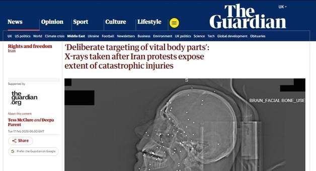 "머리에 2~5mm 산탄 수십 개"…참혹한 이란 시위자 X레이